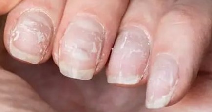 Small white spots on the nails