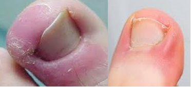 Swelling of the flesh attached to the nails