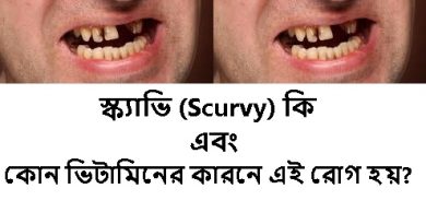 স্ক্যাভি (Scurvy)