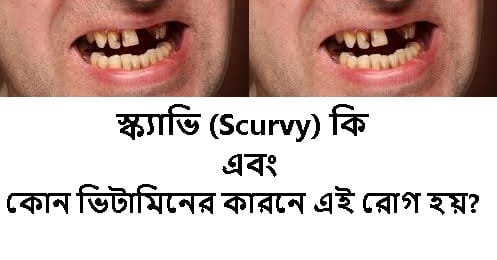 স্ক্যাভি (Scurvy)